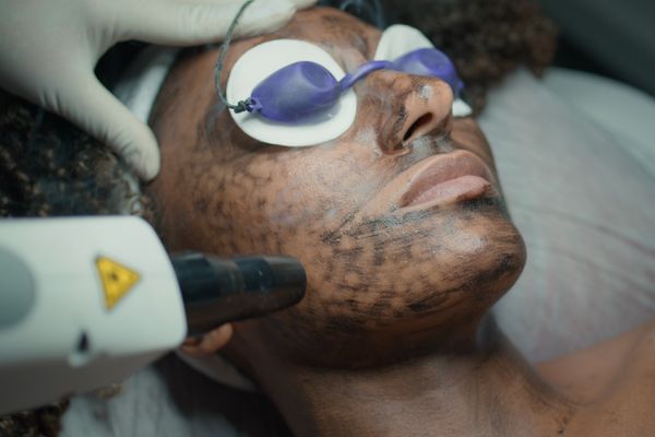 Fractional CO2 Laser treatment