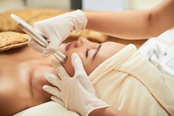 Subcision acne scar treatment