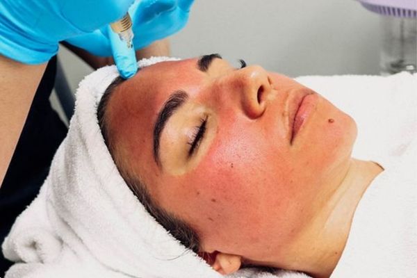 Vampire Facia treatment